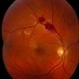 Branch Retinal Artery Occlusion Branch Retinal Artery Occlusion